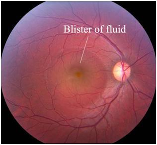 Santral Seröz Retinopati