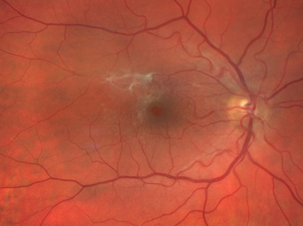 Epiretinal Membran