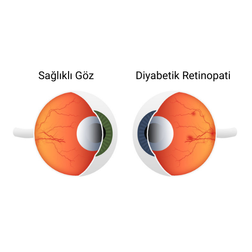 Diyabetik Retinopati