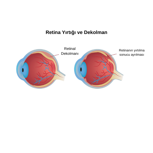 Retina Yırtığı ve Dekolman