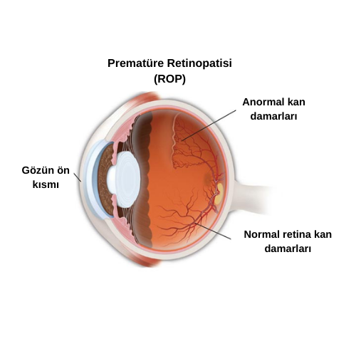 Prematüre Retinopatisi