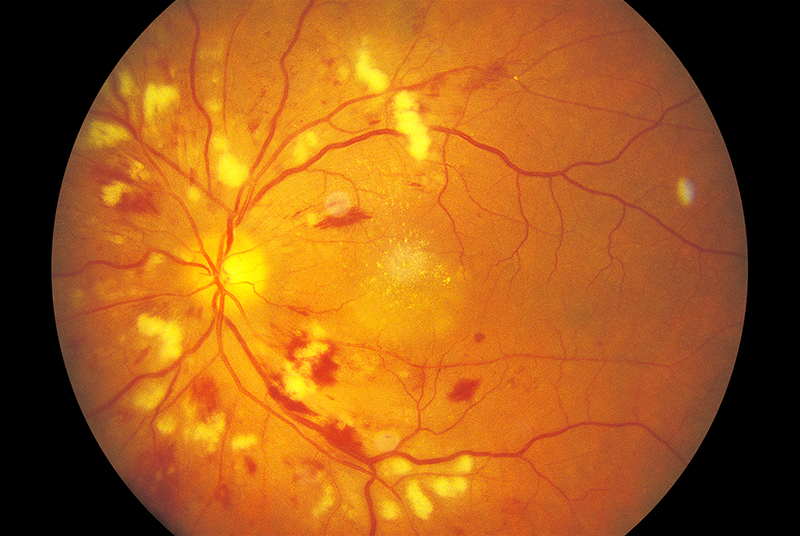 Hipertansif Retinopati