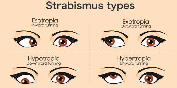 Strabismus (Şaşılık)