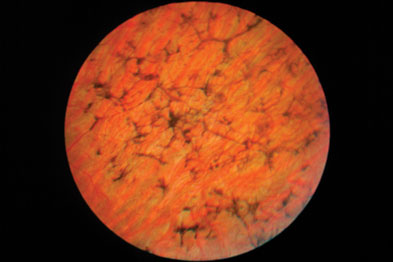 Retinitis Pigmentosa