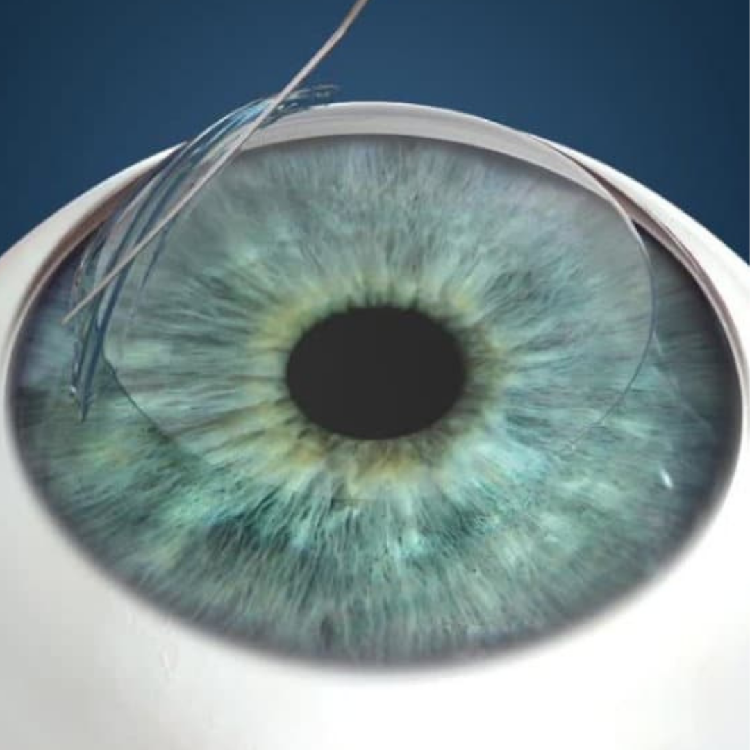 Lasik Ameliyatı